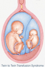 Twin to Twin Transfusion Syndrome